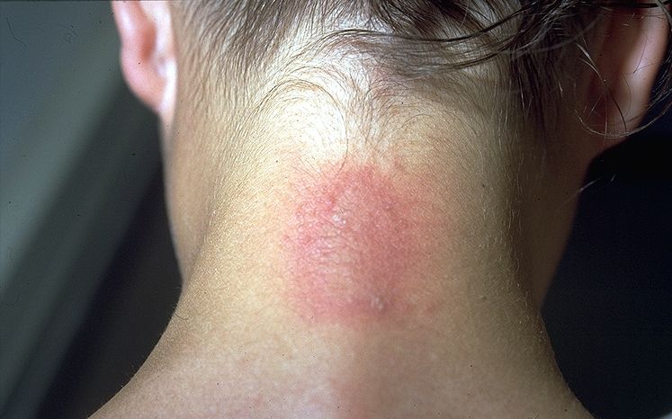 pederus dermatitis