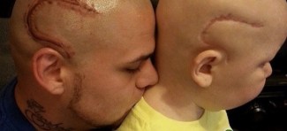 Otac istetovirao ožiljak na glavi iz solidarnosti sa sinom