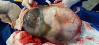 Jednom u 80.000 porođaja: Beba rođena u netaknutom vodenjaku