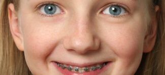 Posledice savremenog odgajanja: Svako treće dete ima anomaliju lica i vilice