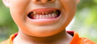 Karijes na mlečnim zubima: Da li se zub pod infekcijom vadi ili ostavlja da ‘čuva mesto’?