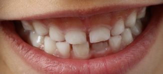 Sve što treba da znamo o zdravlju zuba naše dece