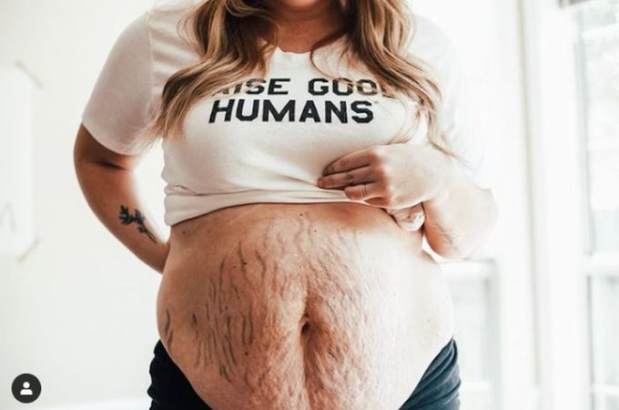 Strije, ožiljci, višak kože… Ove mame pokazale su kako stomak posle porođaja zaista izgleda (FOTO)