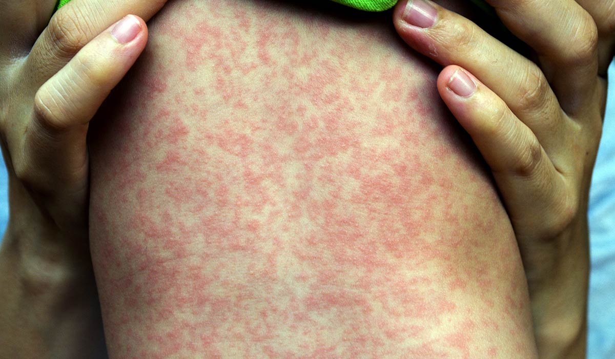 epidemija malih boginja