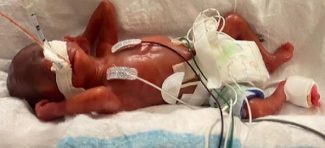 On je najranije rođeno dete na svetu koje je preživelo i sada ima 16 meseci
